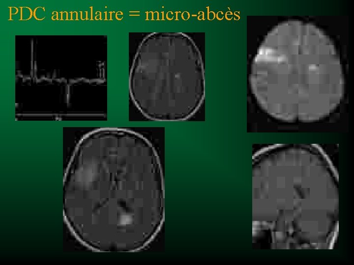 PDC annulaire = micro-abcès 