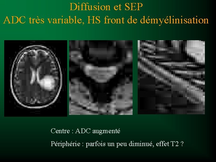 Diffusion et SEP ADC très variable, HS front de démyélinisation Centre : ADC augmenté