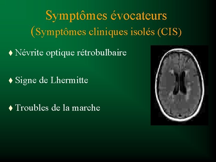 Symptômes évocateurs (Symptômes cliniques isolés (CIS) t Névrite optique rétrobulbaire t Signe de Lhermitte