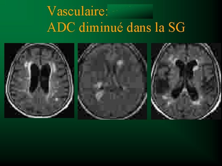 Vasculaire ou SEP Vasculaire: ADC diminué dans la SG 