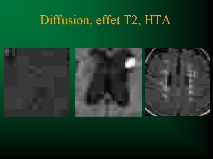Diffusion, effet T 2, HTA 