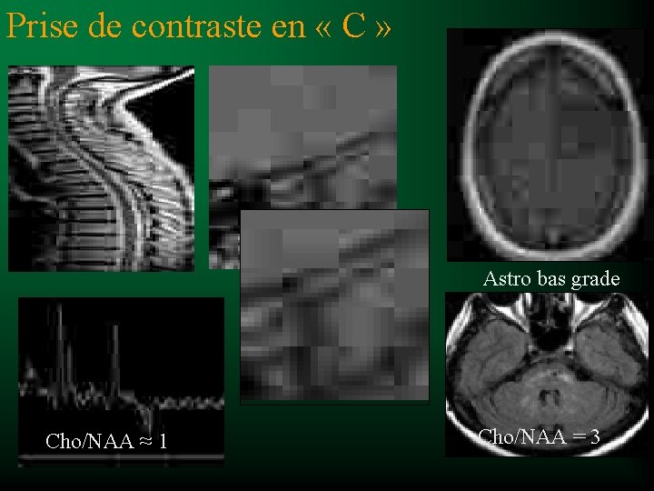 Prise de contraste en « C » Astro bas grade Cho/NAA ≈ 1 Cho/NAA
