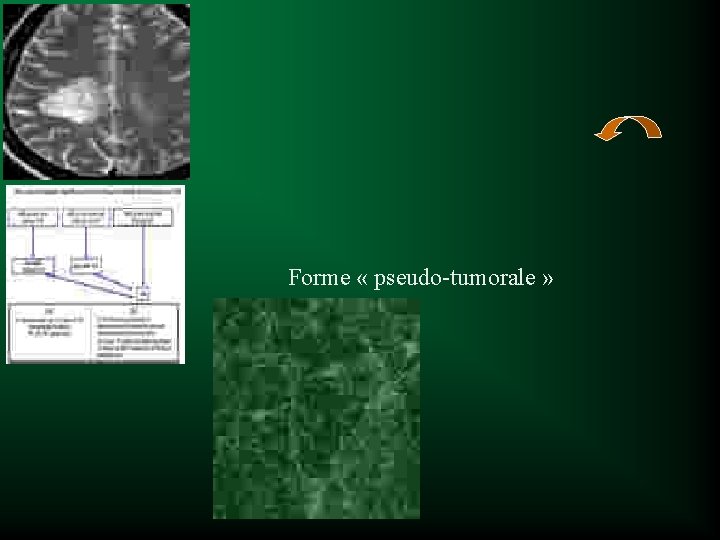 Forme « pseudo-tumorale » 