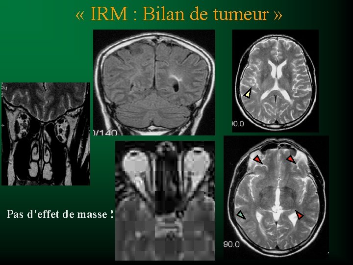  « IRM : Bilan de tumeur » Pas d’effet de masse ! 