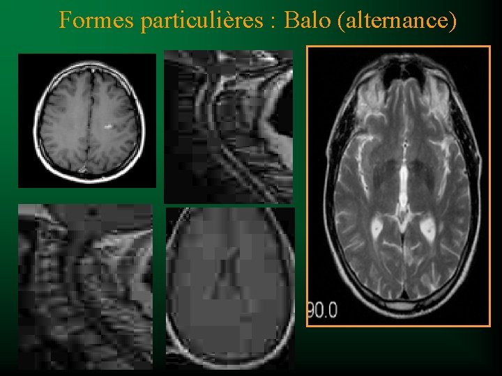 Formes particulières : Balo (alternance) 