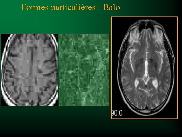 Formes particulières : Balo 
