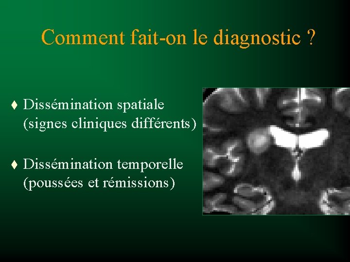 Comment fait-on le diagnostic ? t Dissémination spatiale (signes cliniques différents) t Dissémination temporelle