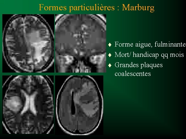 Formes particulières : Marburg t t t Forme aigue, fulminante Mort/ handicap qq mois