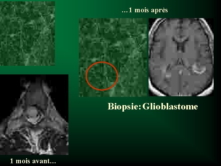 … 1 mois après Biopsie: Glioblastome 1 mois avant… 