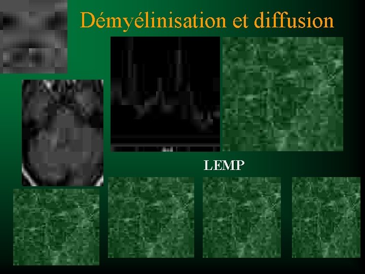 Démyélinisation et diffusion LEMP 
