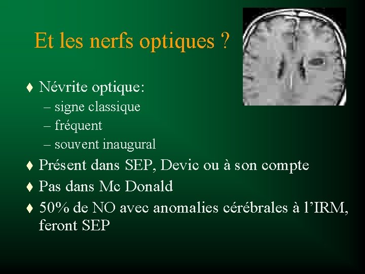 Et les nerfs optiques ? t Névrite optique: – signe classique – fréquent –