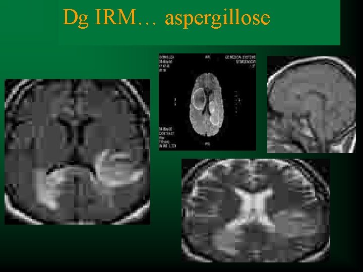 Dg IRM… aspergillose Dg clinique NO … 