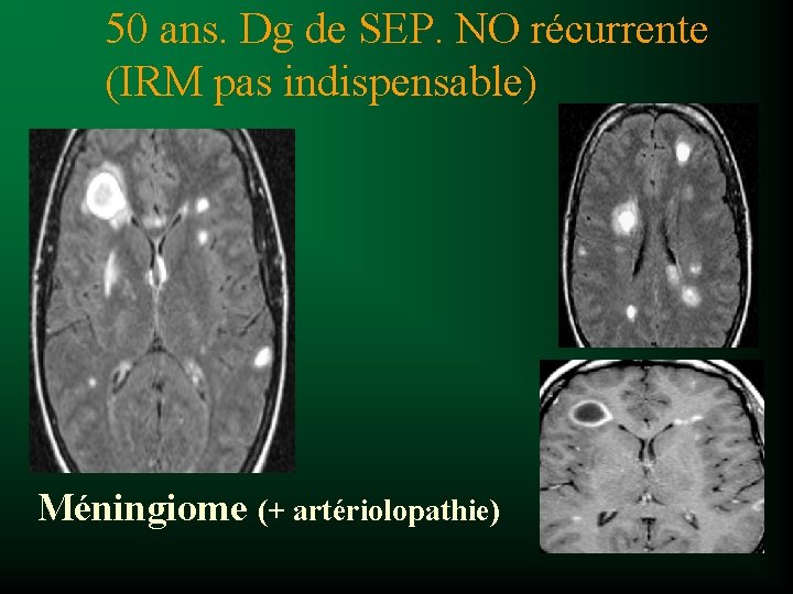 50 ans. Dg de SEP. NO récurrente (IRM pas indispensable) Méningiome (+ artériolopathie) 