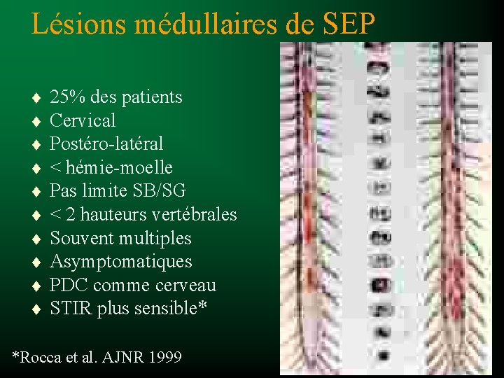 Lésions médullaires de SEP t t t t t 25% des patients Cervical Postéro-latéral