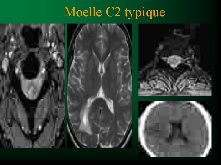 Moelle C 2 typique 