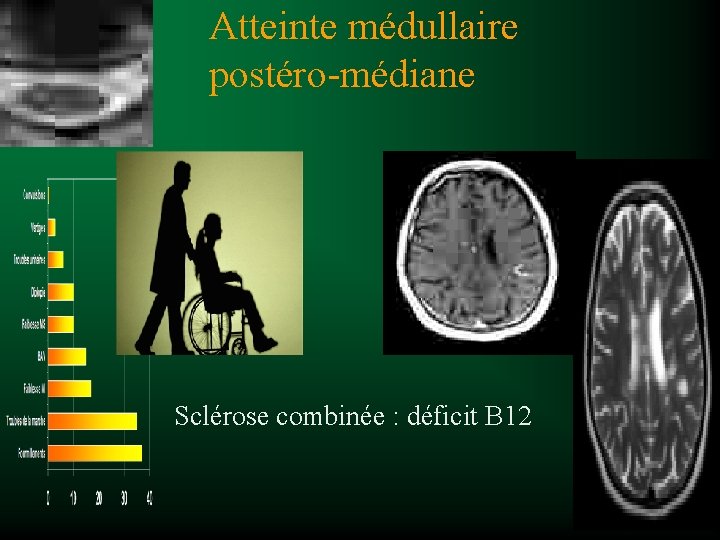 Atteinte médullaire postéro-médiane Sclérose combinée : déficit B 12 