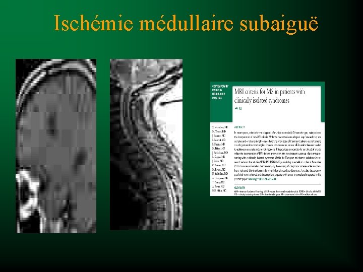 Ischémie médullaire subaiguë 