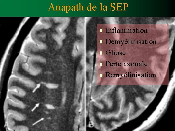 Anapath de la SEP t t t Inflammation Démyélinisation Gliose Perte axonale Remyélinisation 