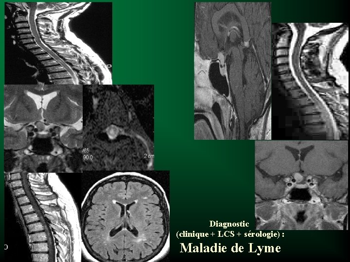 Diagnostic (clinique + LCS + sérologie) : Maladie de Lyme 