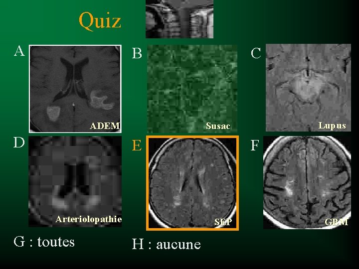 Quiz A B ADEM D C E Arteriolopathie G : toutes Lupus Susac F