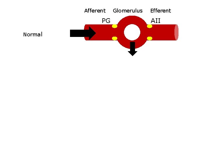 Afferent Glomerulus Efferent PG AII ↑PG ↑AII Normal ↓volume NSAIDS ↓PG ↓volume with ACEi