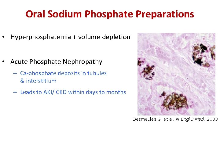 Oral Sodium Phosphate Preparations • Hyperphosphatemia + volume depletion • Acute Phosphate Nephropathy –