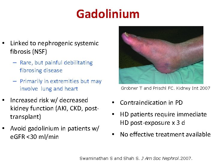 Gadolinium • Linked to nephrogenic systemic fibrosis (NSF) – Rare, but painful debilitating fibrosing