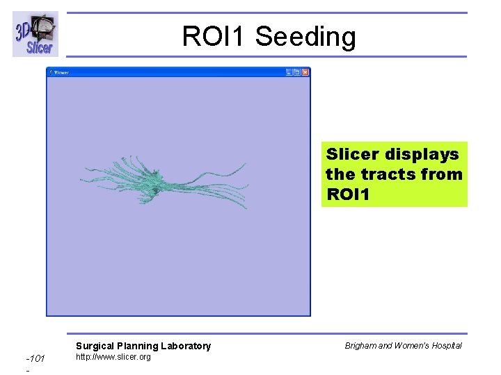 ROI 1 Seeding Slicer displays the tracts from ROI 1 Surgical Planning Laboratory -101