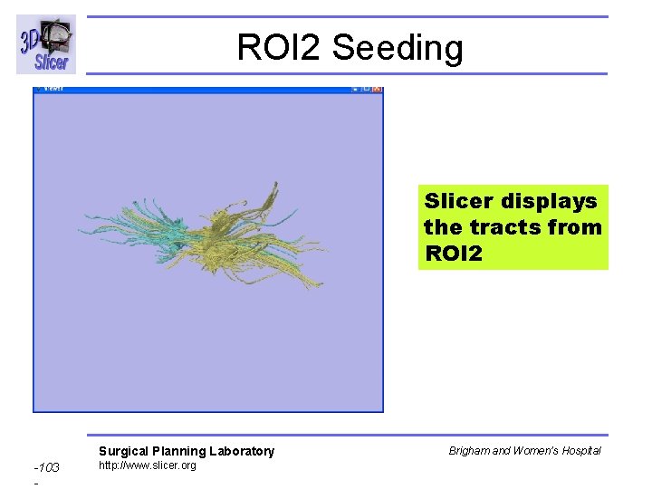 ROI 2 Seeding Slicer displays the tracts from ROI 2 Surgical Planning Laboratory -103
