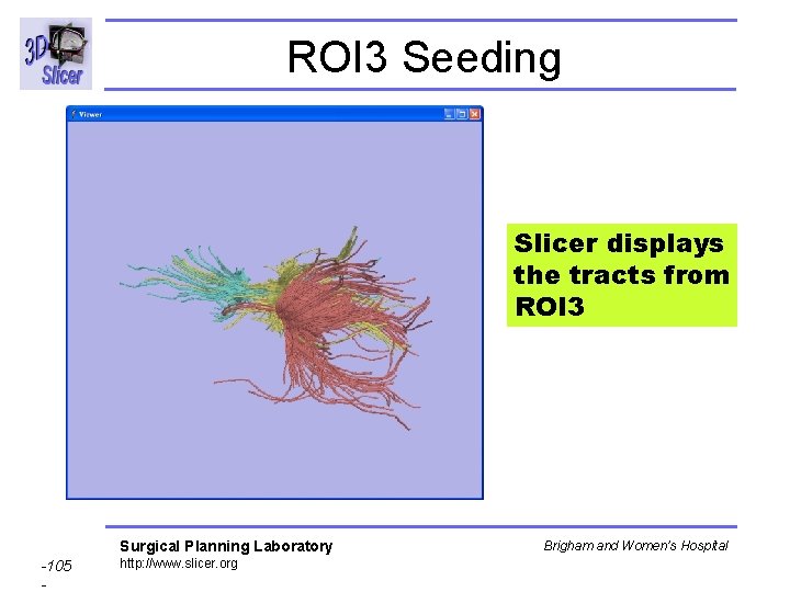 ROI 3 Seeding Slicer displays the tracts from ROI 3 Surgical Planning Laboratory -105