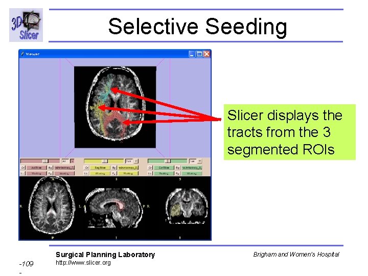 Selective Seeding Slicer displays the tracts from the 3 segmented ROIs Surgical Planning Laboratory