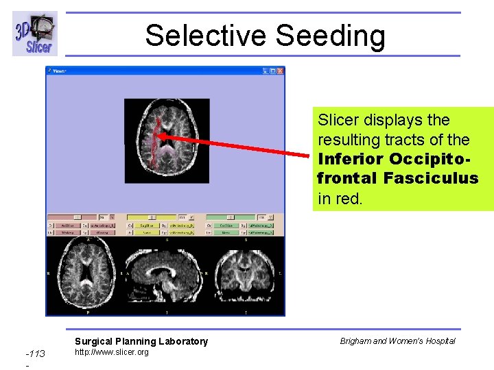 Selective Seeding Slicer displays the resulting tracts of the Inferior Occipitofrontal Fasciculus in red.