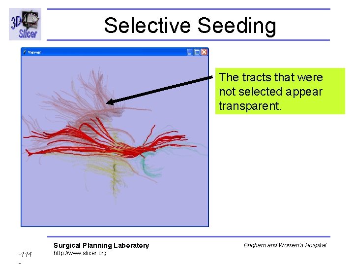 Selective Seeding The tracts that were not selected appear transparent. Surgical Planning Laboratory -114