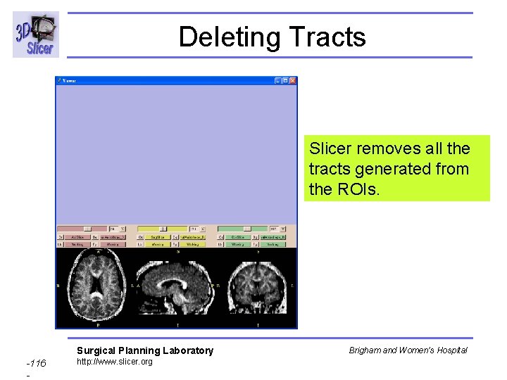 Deleting Tracts Slicer removes all the tracts generated from the ROIs. Surgical Planning Laboratory