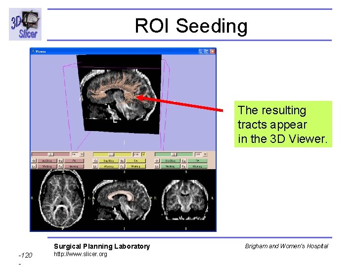 ROI Seeding The resulting tracts appear in the 3 D Viewer. Surgical Planning Laboratory