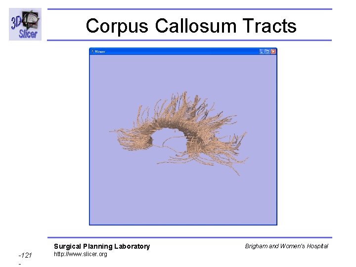Corpus Callosum Tracts Surgical Planning Laboratory -121 - http: //www. slicer. org Brigham and