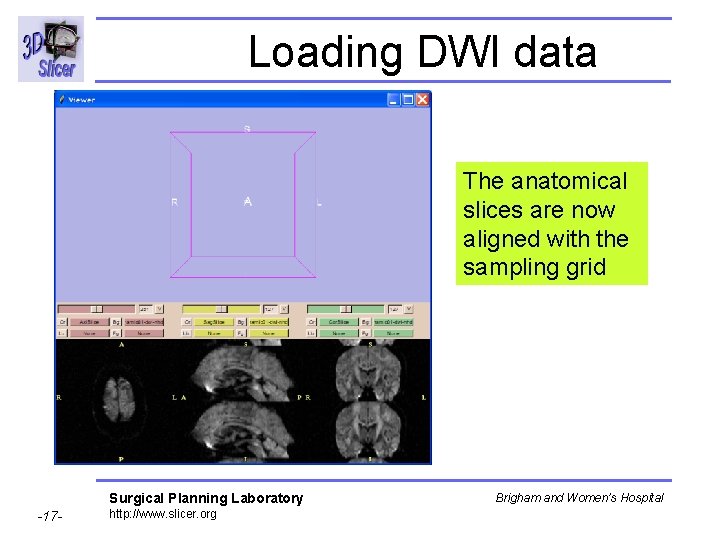 Loading DWI data The anatomical slices are now aligned with the sampling grid Surgical
