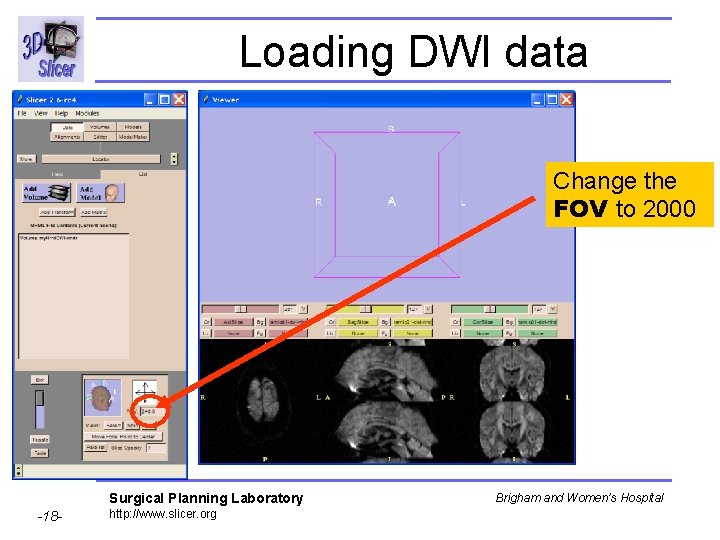 Loading DWI data Change the FOV to 2000 Surgical Planning Laboratory -18 - http: