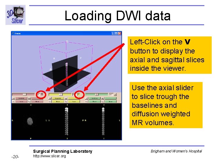 Loading DWI data Left-Click on the V button to display the axial and sagittal