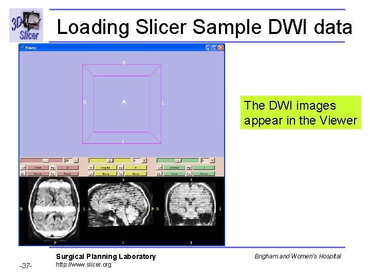 Loading Slicer Sample DWI data The DWI images appear in the Viewer Surgical Planning
