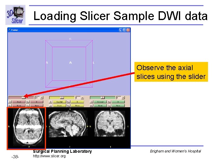Loading Slicer Sample DWI data Observe the axial slices using the slider Surgical Planning