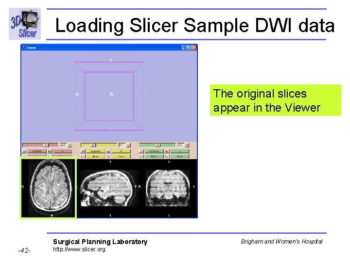 Loading Slicer Sample DWI data The original slices appear in the Viewer Surgical Planning