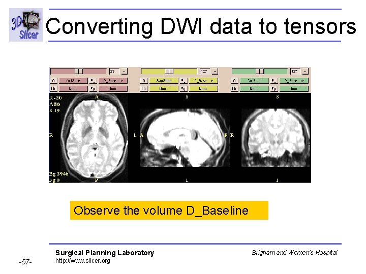 Converting DWI data to tensors Observe the volume D_Baseline Surgical Planning Laboratory -57 -