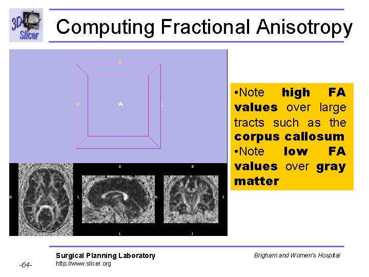 Computing Fractional Anisotropy • Note high FA values over large tracts such as the