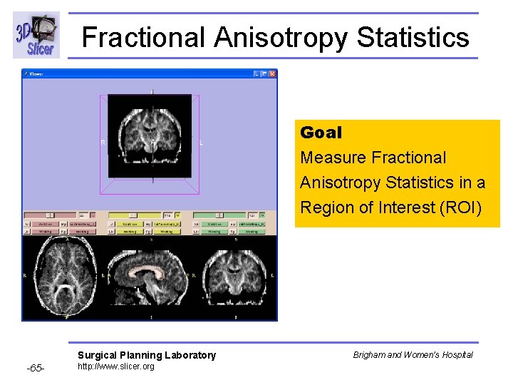 Fractional Anisotropy Statistics Goal Measure Fractional Anisotropy Statistics in a Region of Interest (ROI)