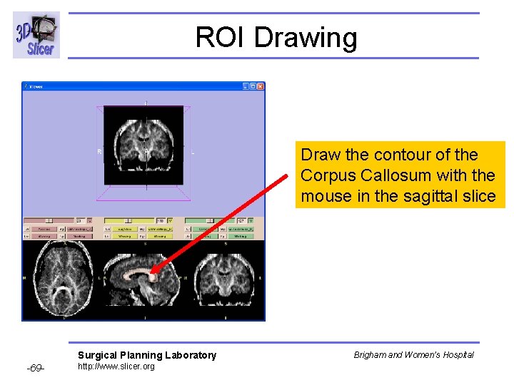 ROI Drawing Draw the contour of the Corpus Callosum with the mouse in the