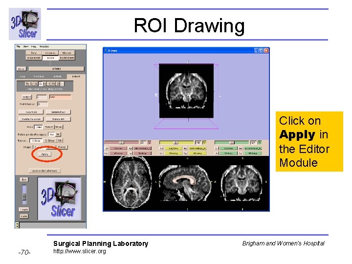 ROI Drawing Click on Apply in the Editor Module Surgical Planning Laboratory -70 -