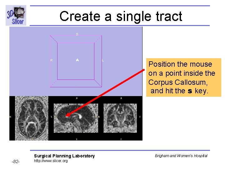 Create a single tract Position the mouse on a point inside the Corpus Callosum,