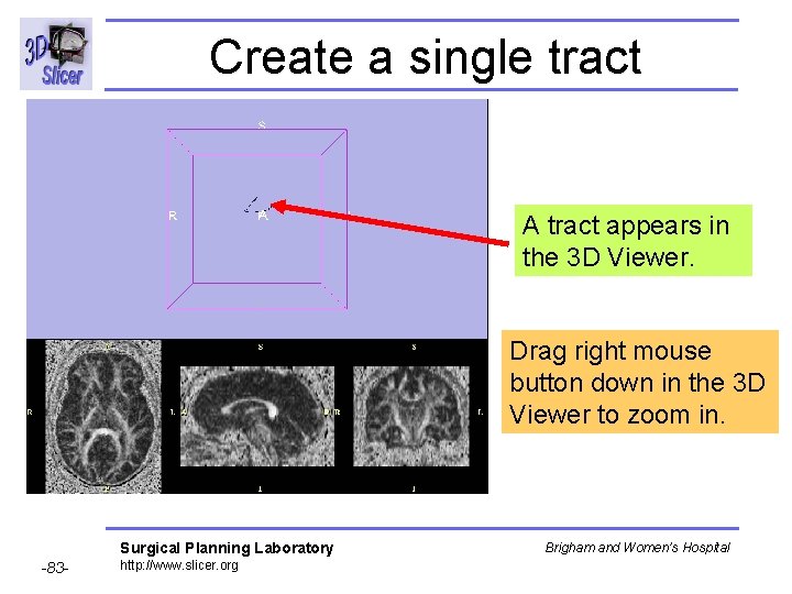 Create a single tract A tract appears in the 3 D Viewer. Drag right