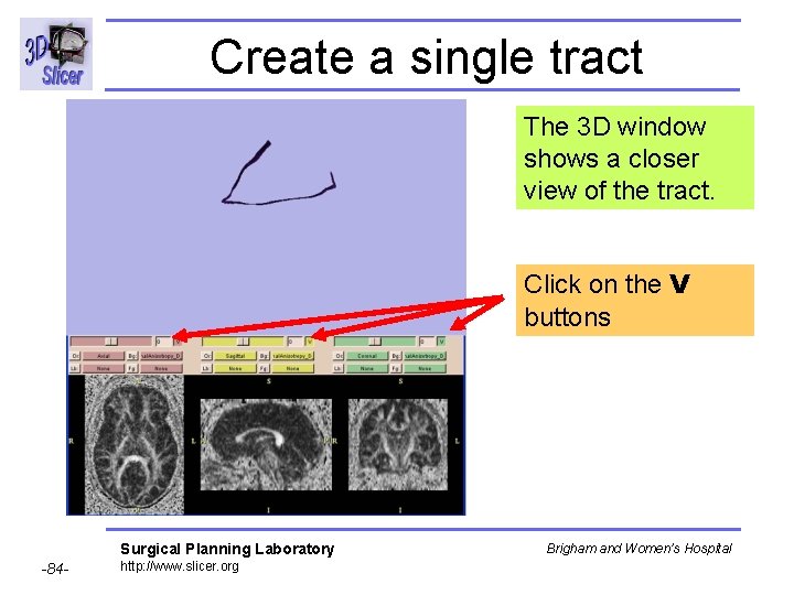 Create a single tract The 3 D window shows a closer view of the